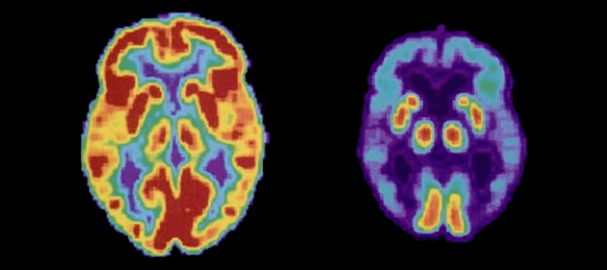 RESEARCH HIGHLIGHT: Association of Extracellular Vesicle Biomarkers With Alzheimer Disease